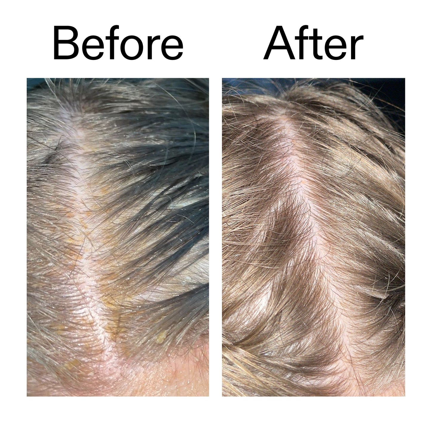 salicylic-acid-exfoliating-scalp-treatment-x8 Salicylic_Acid_Exfoliating_Scalp_Treatment_Before_After_2000x2000_e572a30f-057c-4a48-823b-1c09dc97f8d0.jpg