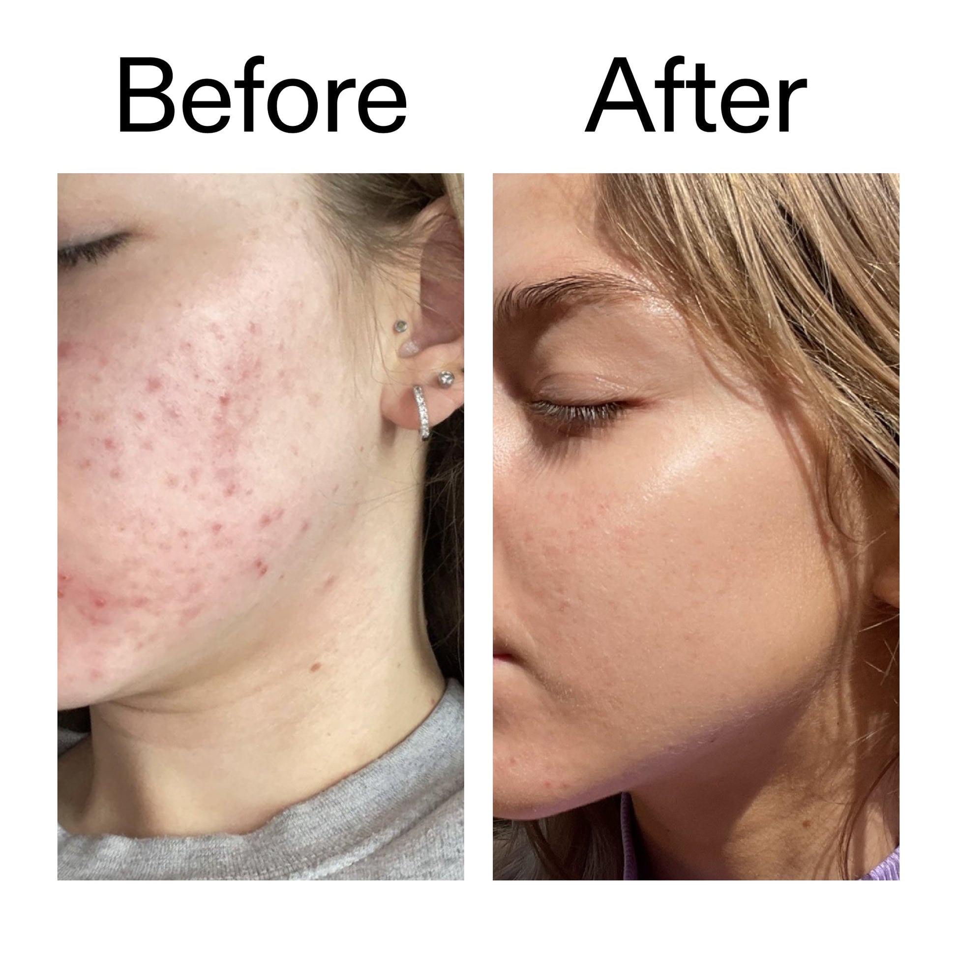 beta-hydroxy-acid-bha-serum-f0 Beta_Hydroxy_Acid_Serum_Before_After_2000x2000_96fda3e5-938d-49ef-bcf2-a0fa6ece4e2c.jpg