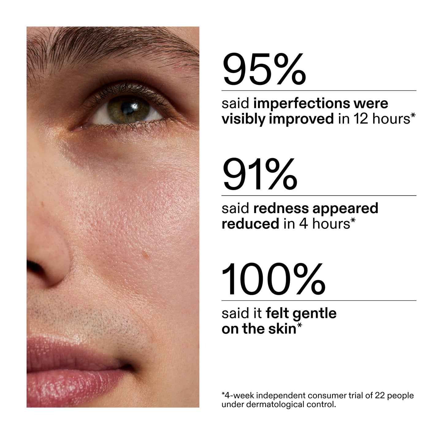 succinic-acid-acne-treatment-u9 CA_Succinic_Acid_Treatment_key_Claims_2000x2000_db91b0f1-7f29-4bfe-bb16-63a47f500960.jpg