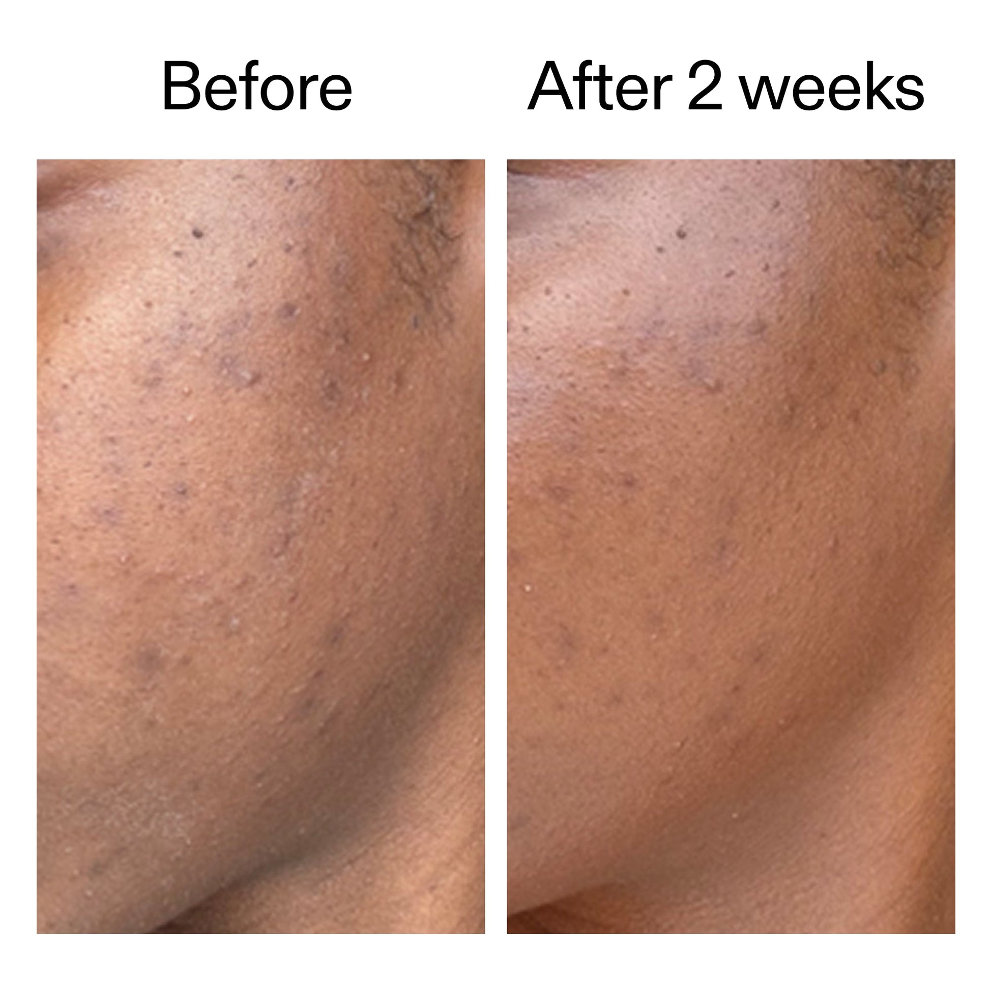 360-acne-clearing-duo-z1 DIOICB_A2000x2000.jpg
