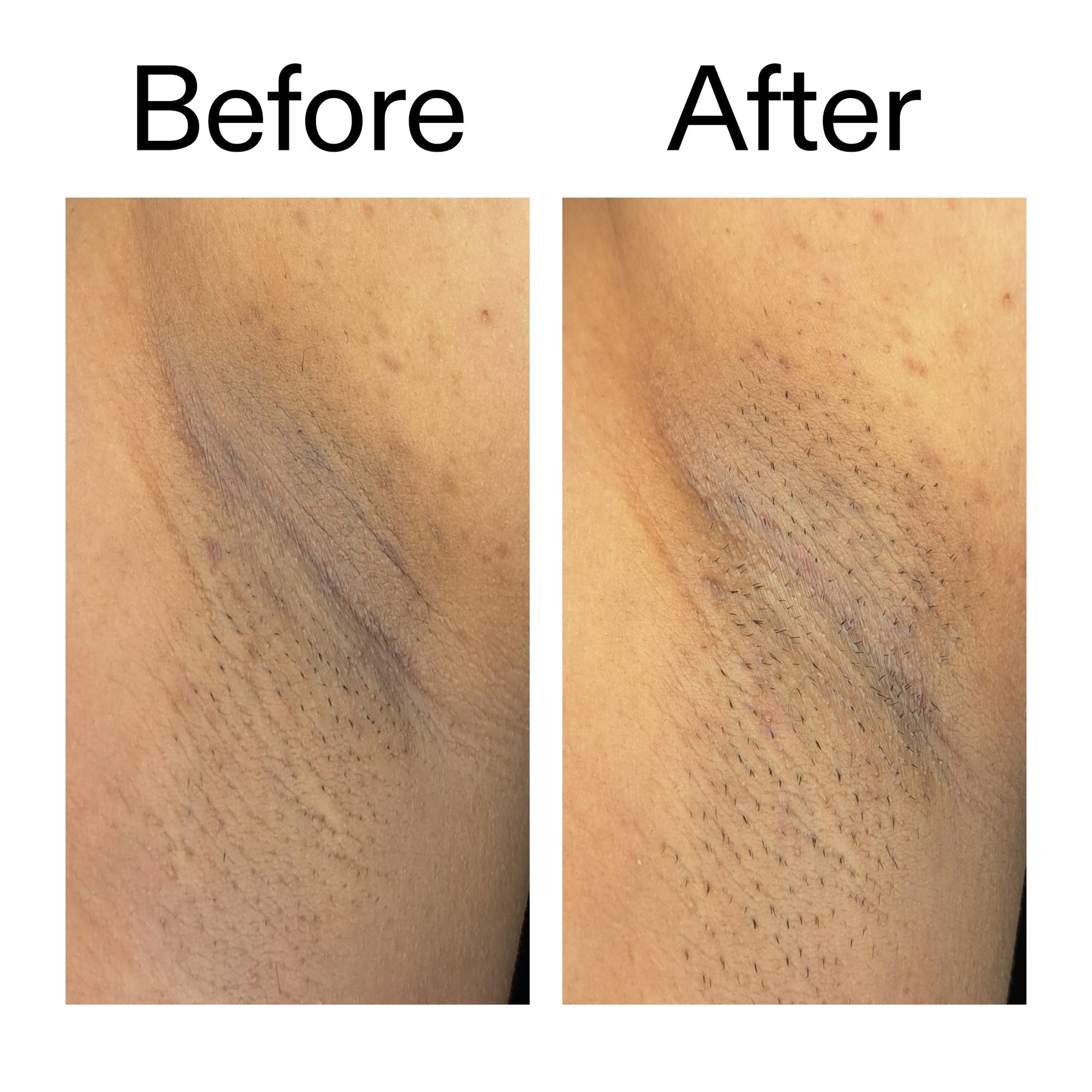glycolic-acid-exfoliating-body-stick-l4 Glycolic_Acid_Exfoliating_Body_Stick_Before_After_V3_2000x2000_ea919cd9-1439-4a46-82a0-76200eb5bb42.jpg