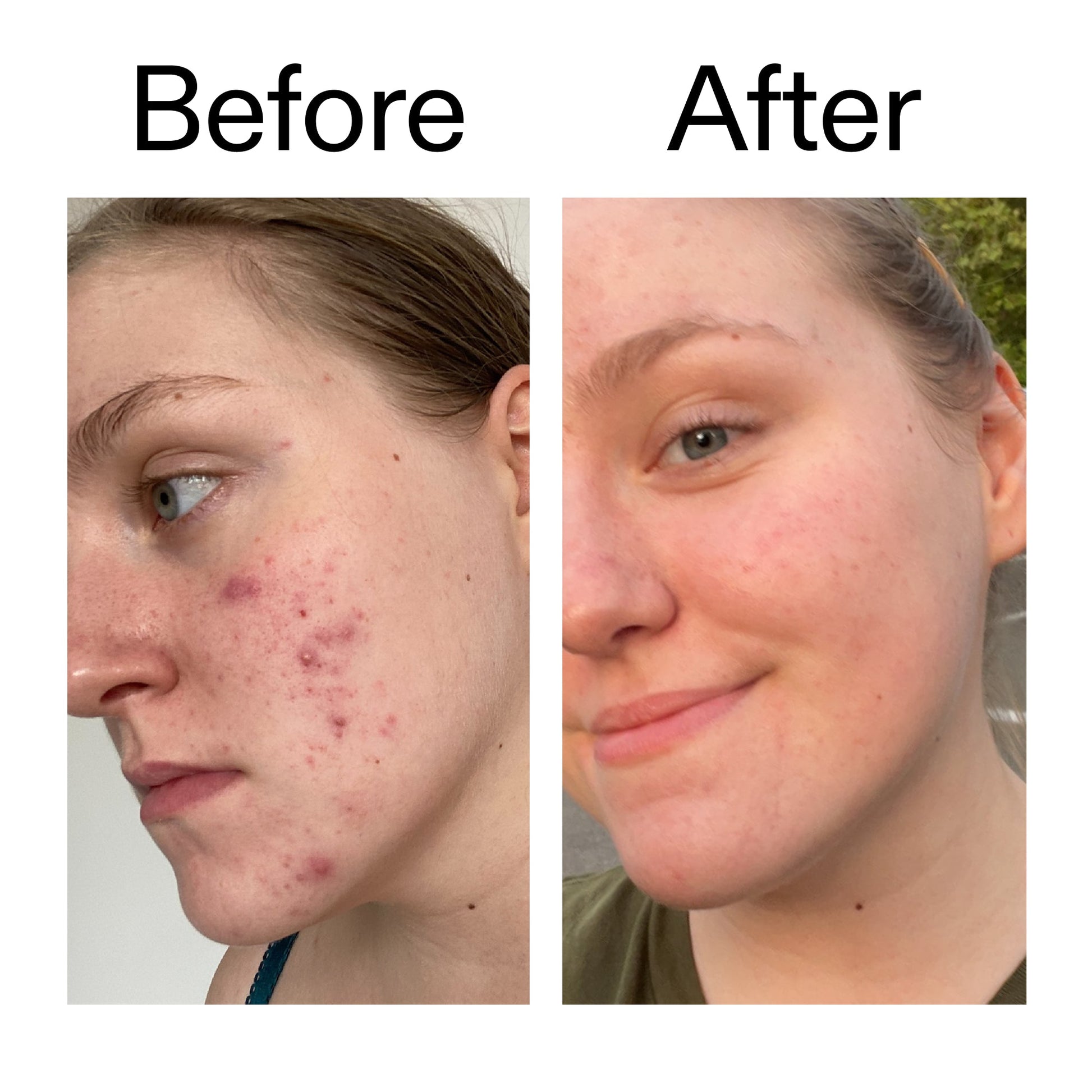 glycolic-acid-toner-r1 Glycolic_Acid_Toner_Before_After_2000x2000_49f0b9f7-e71b-4b2e-a8f8-2ea4b73247bb.jpg