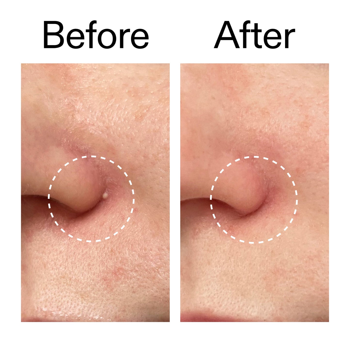 hydrocolloid-invisible-pimple-patches-pack-of-22-j2 Hydrocolloid_Invisible_Pimple_Patches_Before_After_2000x2000_b02aa37b-c78a-4682-91de-9135af5bb7df.jpg