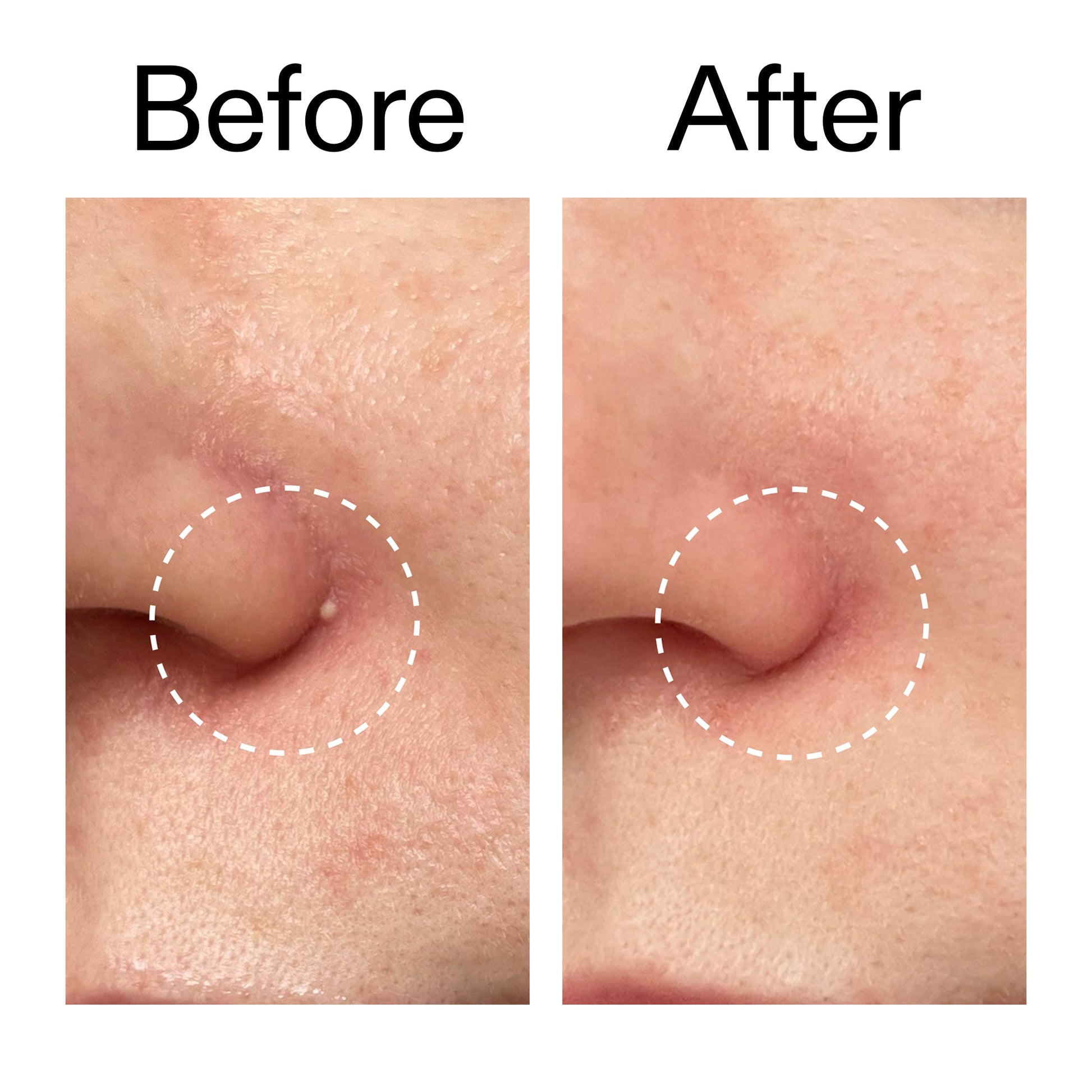 hydrocolloid-invisible-pimple-patches-pack-of-22-j2 Hydrocolloid_Invisible_Pimple_Patches_Before_After_2000x2000_b02aa37b-c78a-4682-91de-9135af5bb7df.jpg