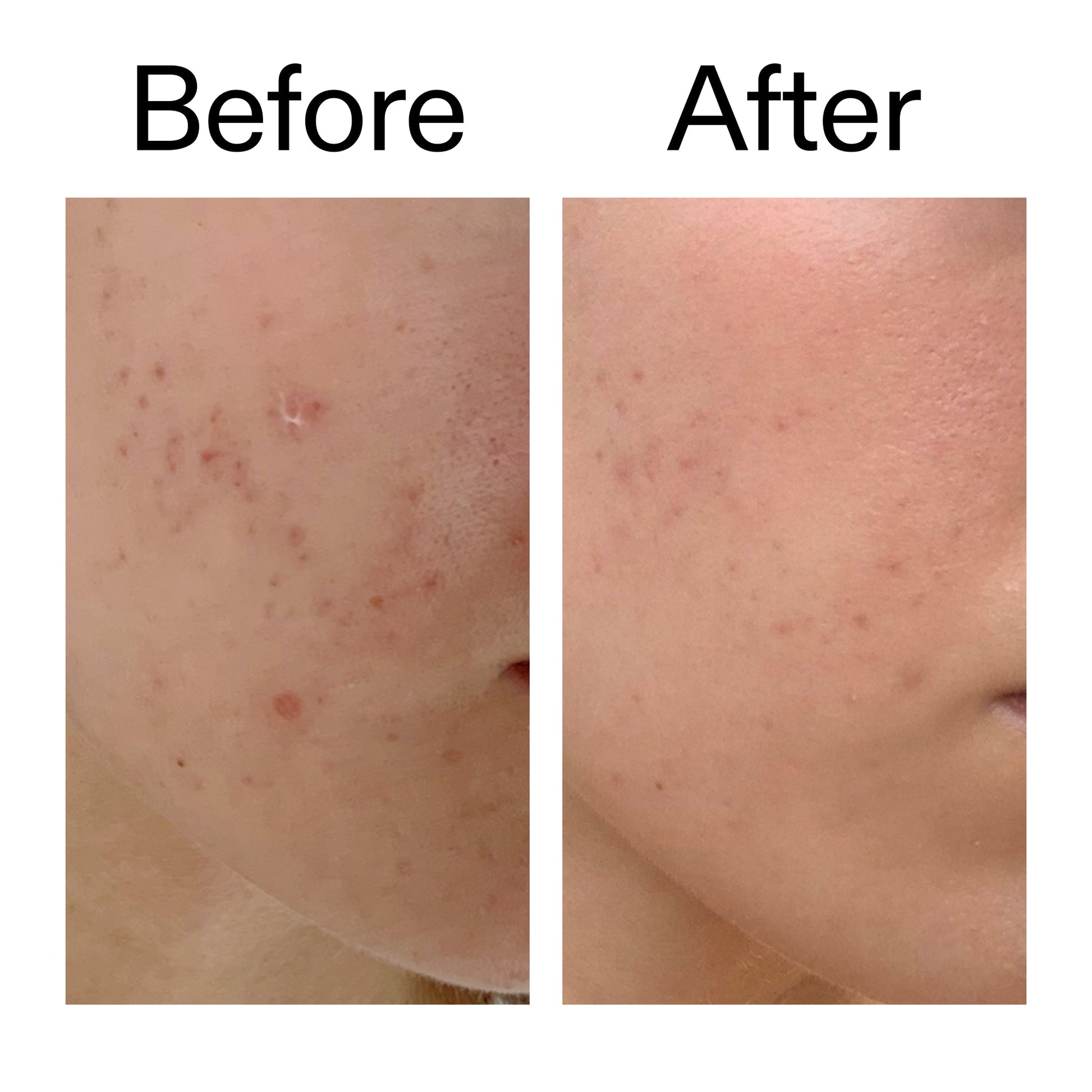 mandelic-acid-treatment-g3 Mandelic_Acid_Treatment_Before_After_2000x2000_4885ac6e-c5d7-4279-a72a-1417af7dce35.jpg