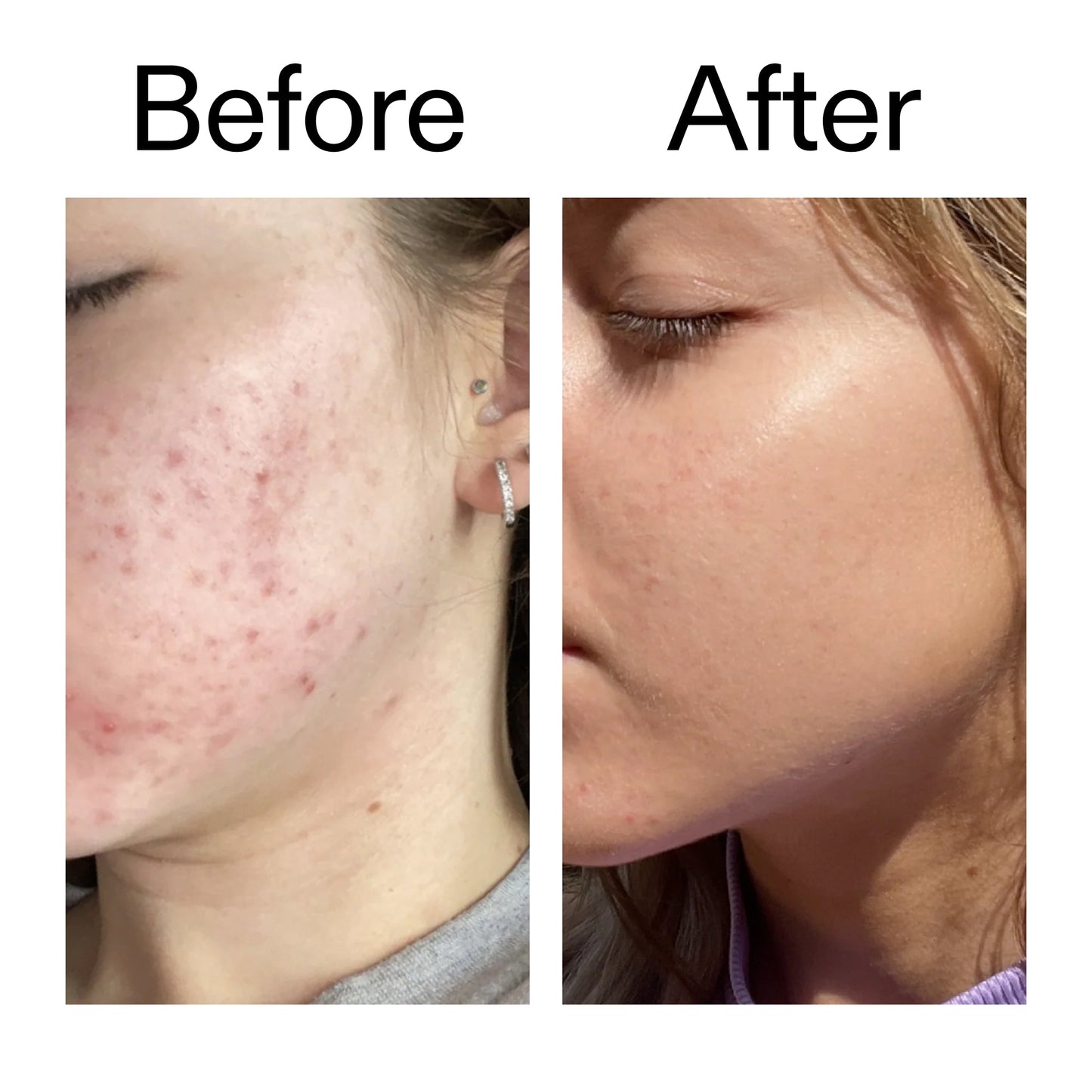 10-niacinamide-serum-duo-t1 Niacinamide_Serum_Before_After_2000x2000_bde32455-9e7d-448e-b053-bef41504f0a9.jpg