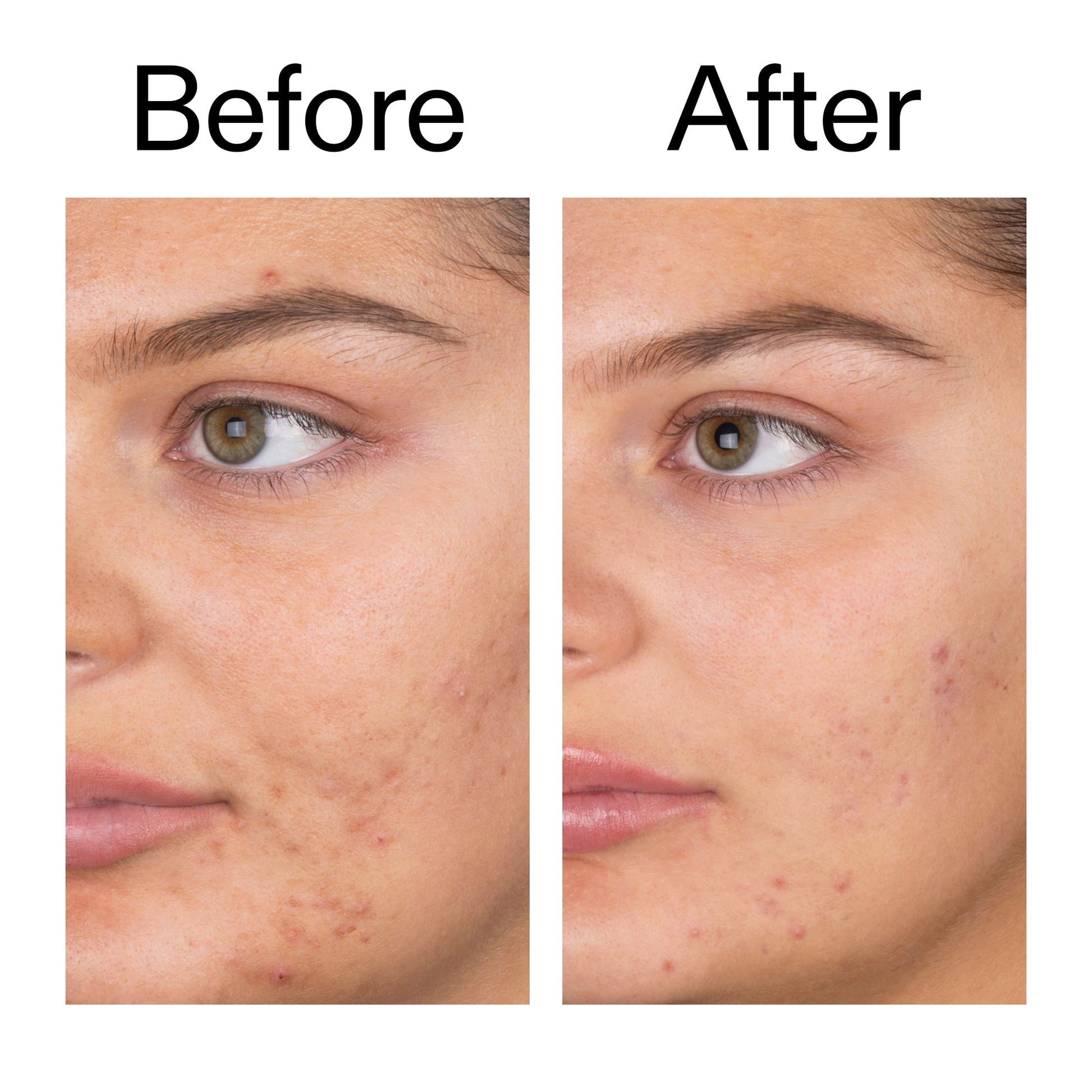salicylic-acid-cleanser-150ml-o3 Salicylic_Acid_Cleanser_-_150ml_Before_After_2000x2000_e7230494-853f-4b07-82b1-27669104c995.jpg
