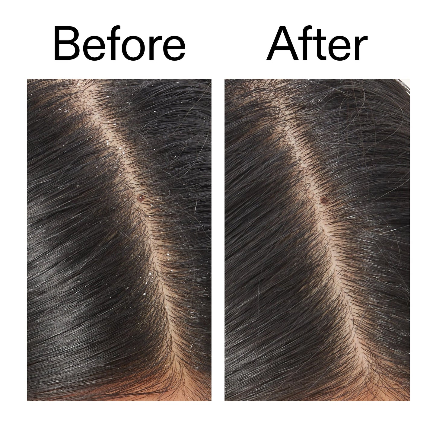 salicylic-acid-exfoliating-scalp-treatment-x8 Salicylic_Acid_Exfoliating_Scalp_Treatment_Before_After_V2_2000x2000_02bd61ad-42bf-490b-b3e3-7e04b2e8a673.jpg
