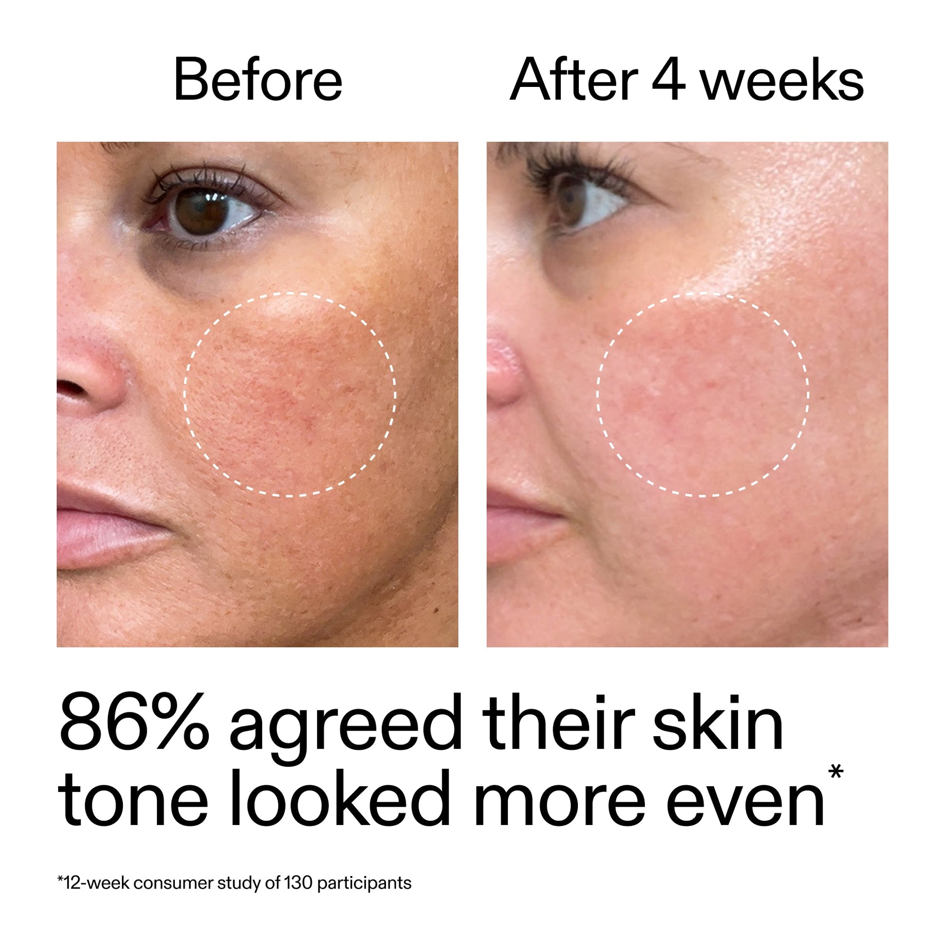 starter-retinol-serum-t0 StarterRetinol_BeforeAfter_Claim2_2000x2000_f5c9ecc0-8d76-429d-bef5-c3a61bcf5c09.jpg