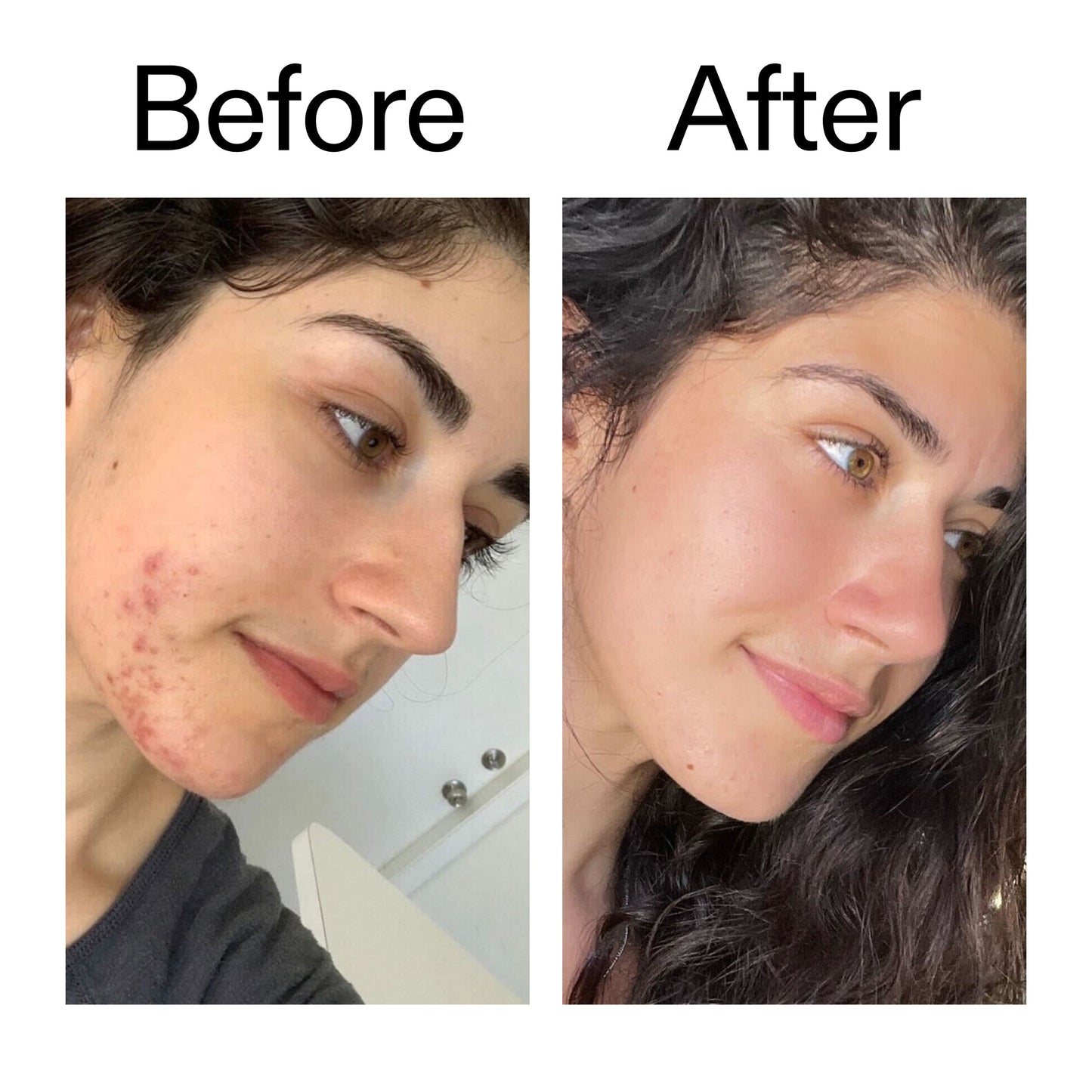 succinic-acid-acne-treatment-u9 Succinic_Acid_Treatment_Before_After_2000x2000_6a5f0054-2f58-4433-9314-0dc72c9bdd3b.jpg
