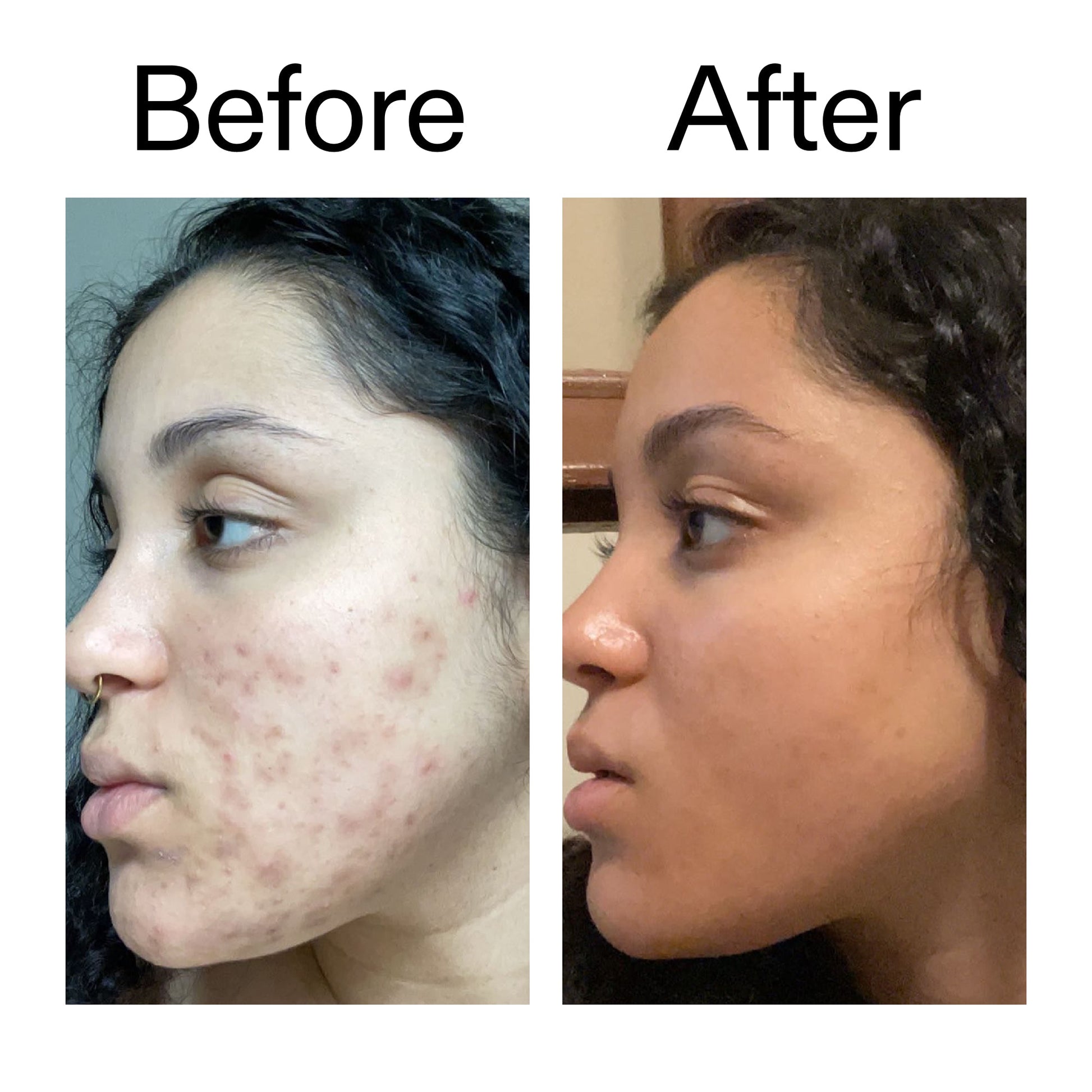 tranexamic-acid-serum-h3 Tranexamic_Acid_Serum_Before_After_2000x2000_98ebc8be-77b0-4843-8a22-90790ebe918b.jpg